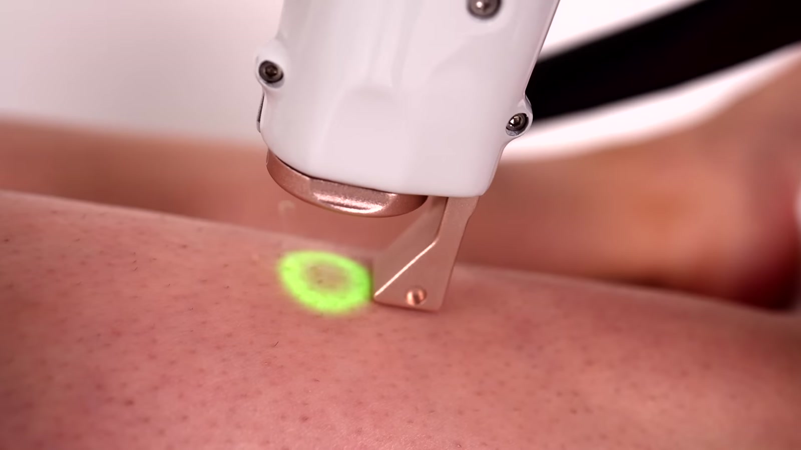 Soin d’épilation laser